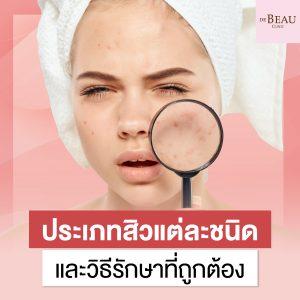 ประเภทสิวแต่ละชนิด และวิธีรักษาที่ถูกต้อง