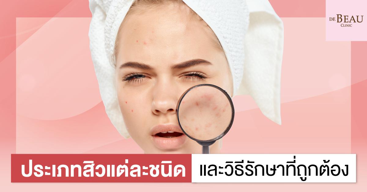 ประเภทสิวแต่ละชนิด และวิธีรักษาที่ถูกต้อง