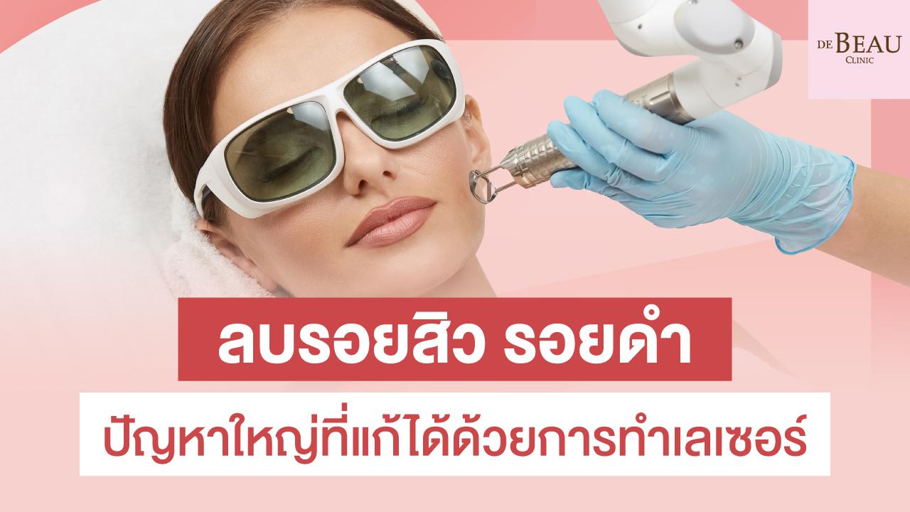 ลบรอยสิว รอยดํา ปัญหาใหญ่ที่แก้ได้ด้วยการทำเลเซอร์