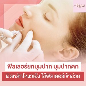 ฟิลเลอร์ยกมุมปาก มุมปากตก ผิดหลักโหงวเฮ้ง ใช้ฟิลเลอร์เข้าช่วย