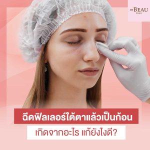 ฉีดฟิลเลอร์ใต้ตาแล้วเป็นก้อน เกิดจากอะไร แก้ยังไงดี?