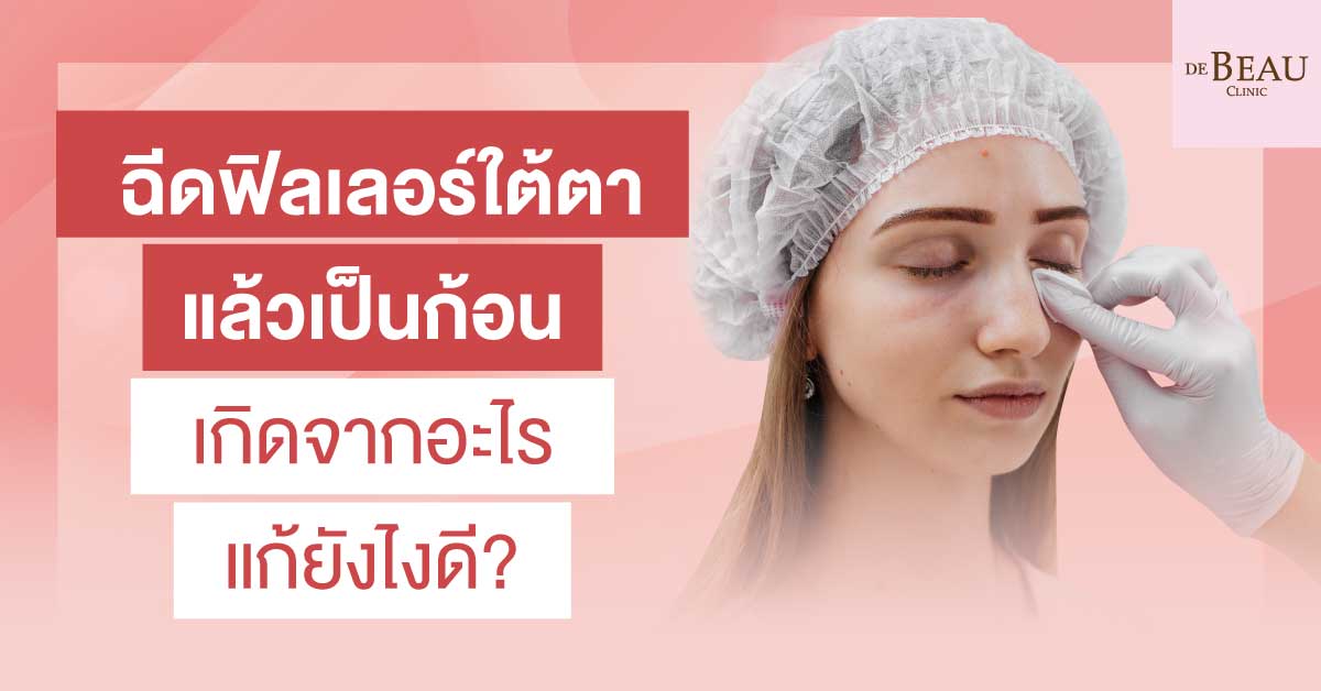 ฉีดฟิลเลอร์ใต้ตาแล้วเป็นก้อน เกิดจากอะไร แก้ยังไงดี?