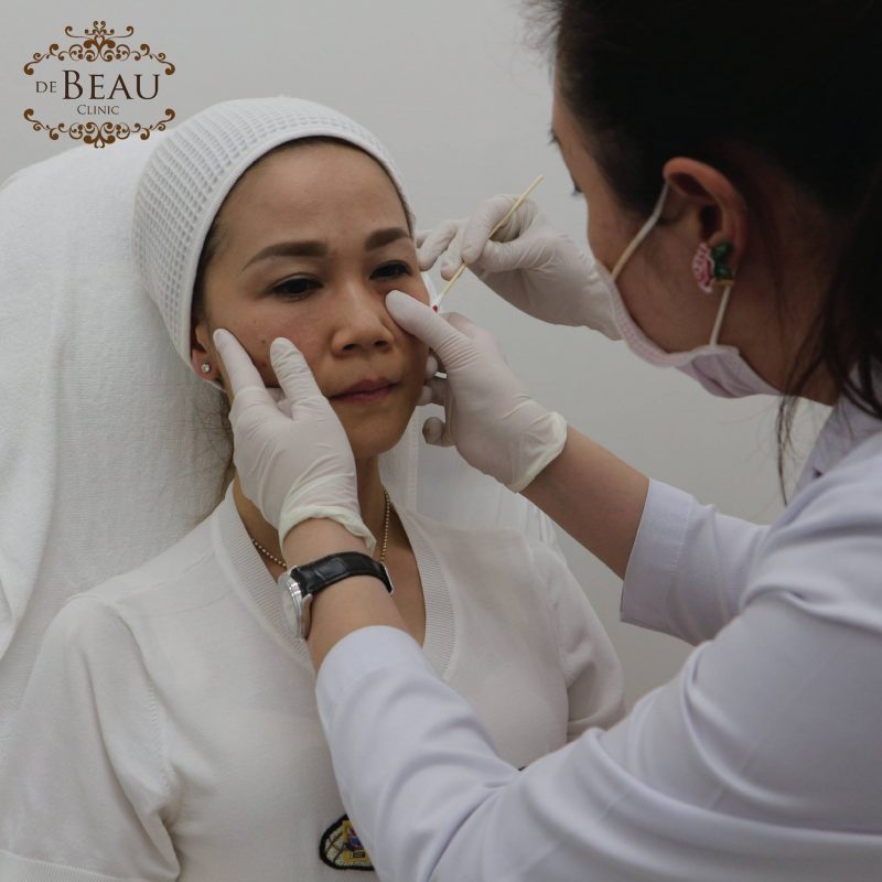 ฉีดฟิลเลอร์แล้วหน้าบวม