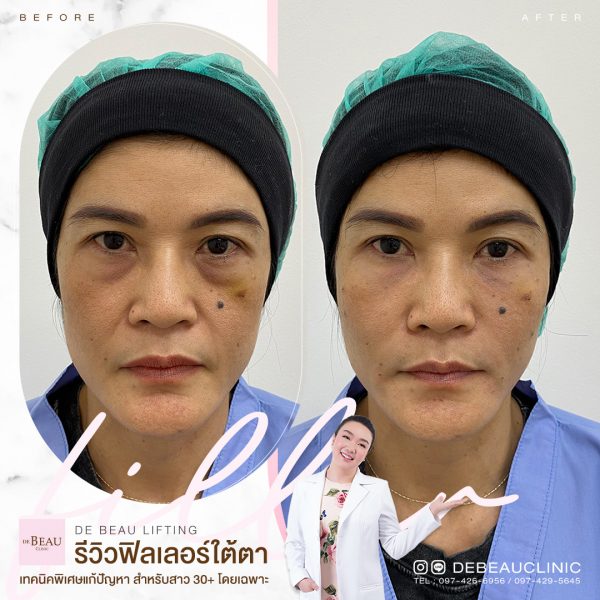 ผิวใต้ตาบาง