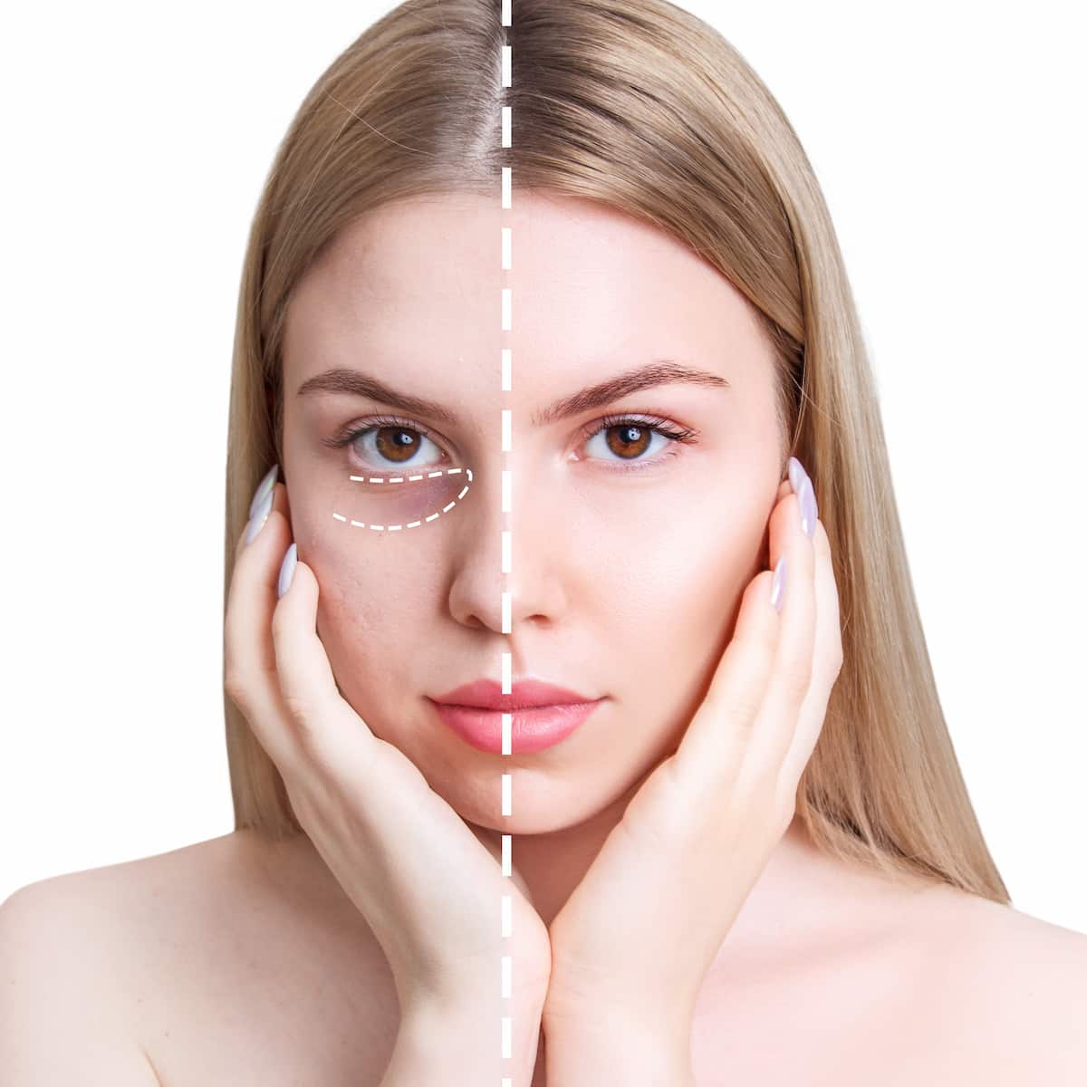 สาเหตุที่ทำให้ฟิลเลอร์ใต้ตากลายเป็นก้อน