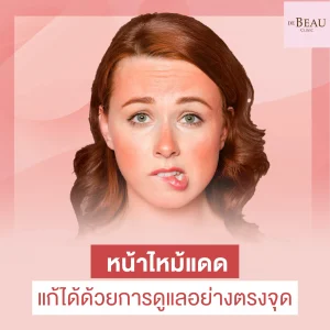 หน้าไหม้แดด