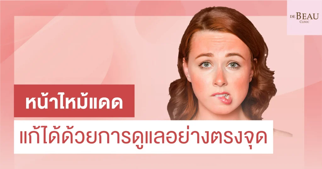 หน้าไหม้แดด