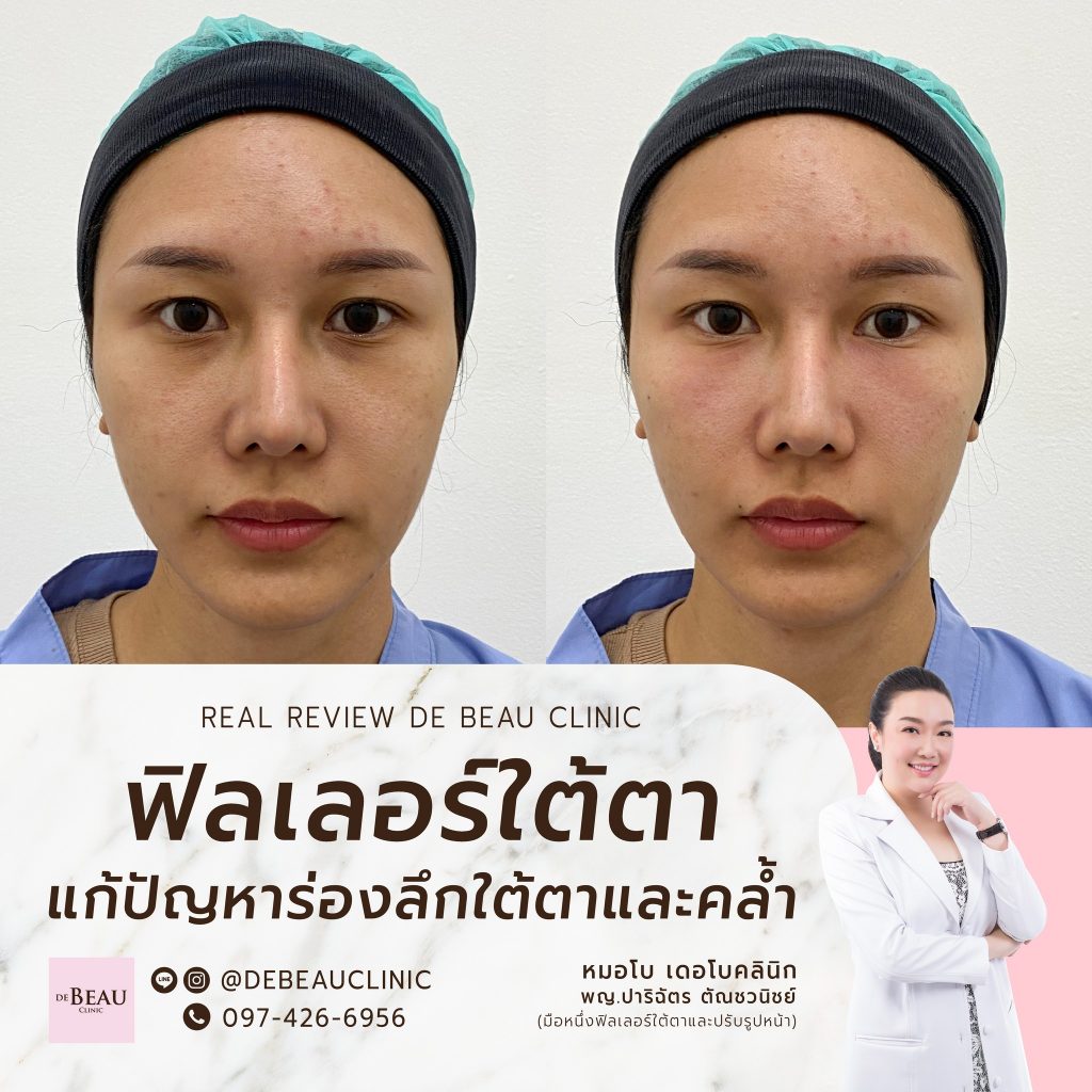 ฉีดฟิลเลอร์แก้ปัญหาใต้ตา