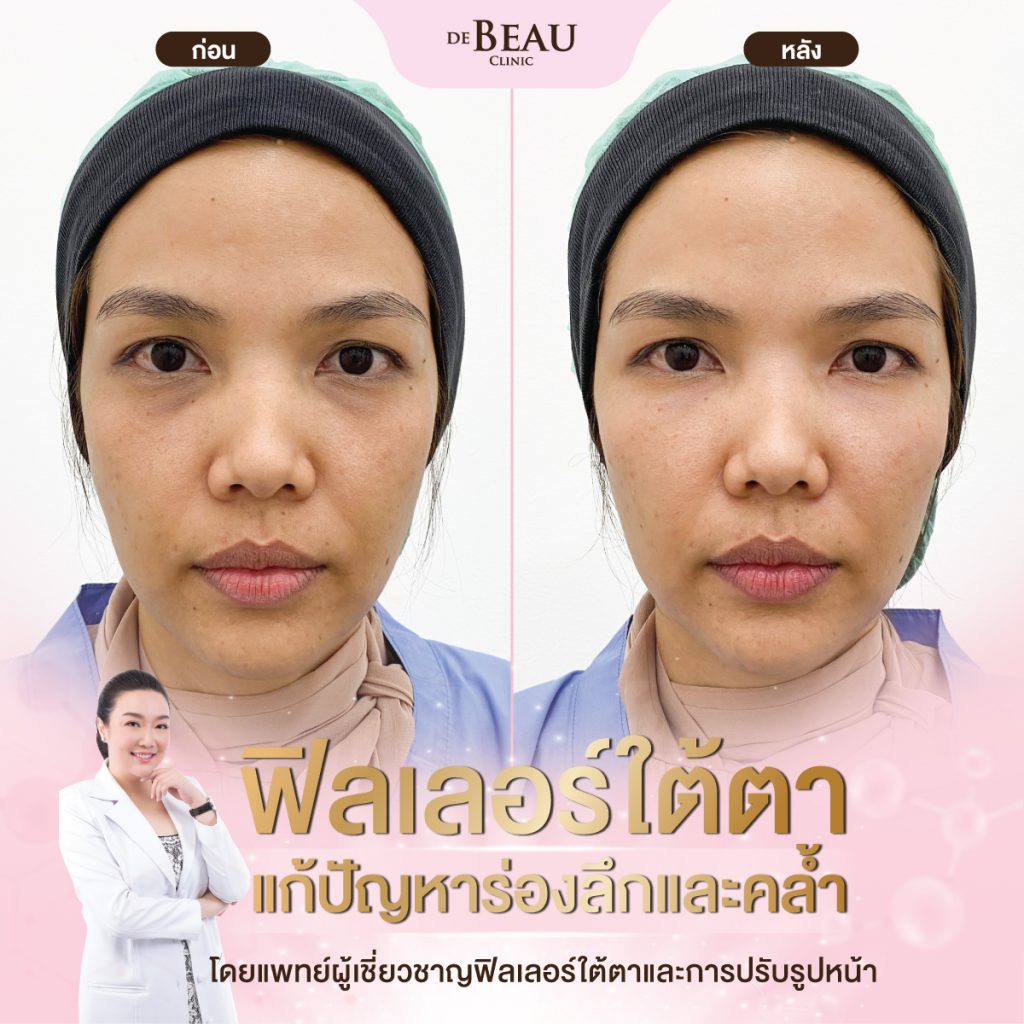 ฉีดฟิลเลอร์แก้ปัญหาใต้ตา