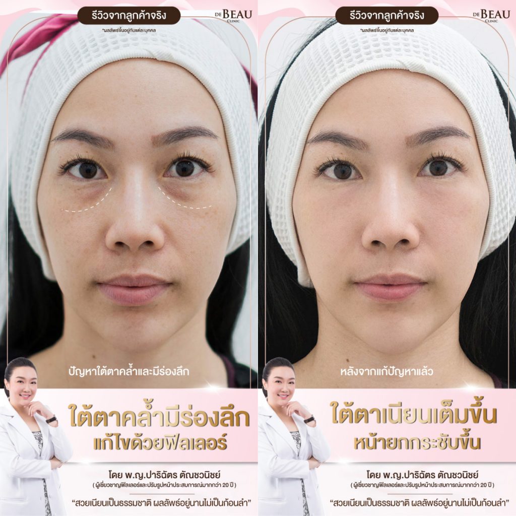 ฉีดฟิลเลอร์แก้ปัญหาใต้ตา