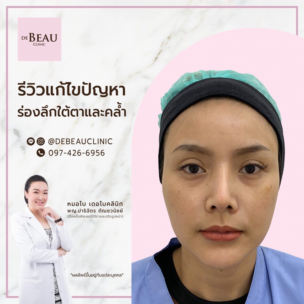 ฉีดฟิลเลอร์แก้ปัญหาใต้ตา