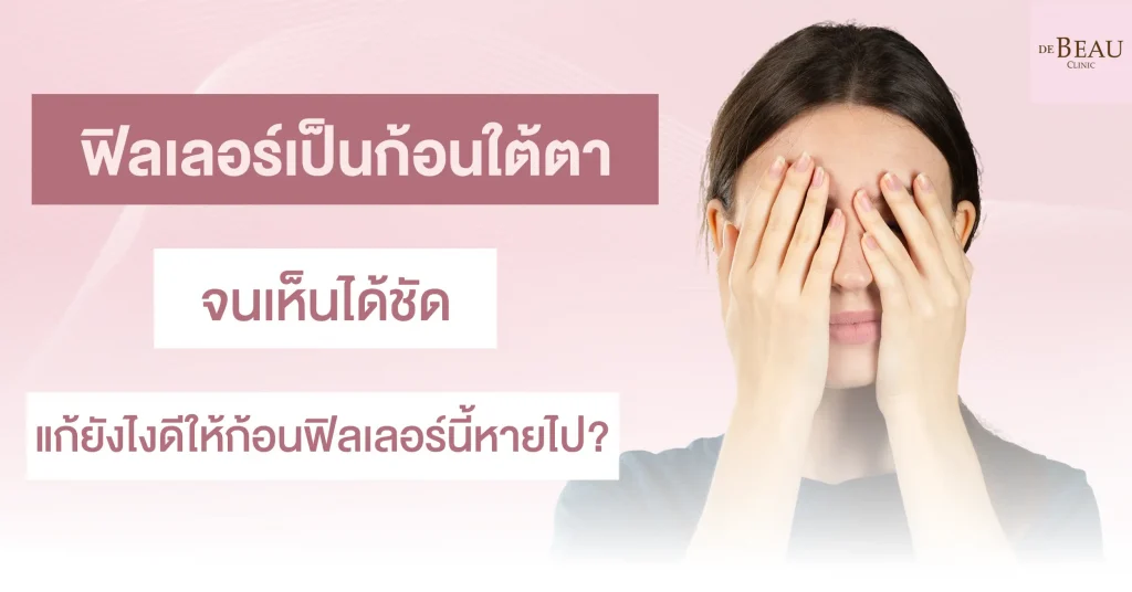 ฟิลเลอร์เป็นก้อนใต้ตา จนเห็นได้ชัด แก้ยังไงดีให้ก้อนฟิลเลอร์นี้หายไป?