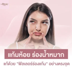 แก้มห้อย ร่องน้ำหมาก แก้ด้วย "ฟิลเลอร์ร่องแก้ม" อย่างตรงจุด