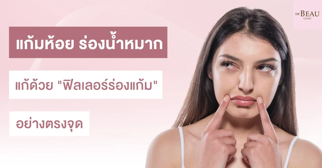 แก้มห้อย ร่องน้ำหมาก แก้ด้วย "ฟิลเลอร์ร่องแก้ม" อย่างตรงจุด
